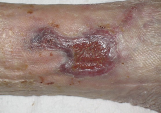 clean exuding wound